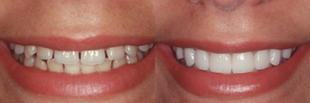 Porcelain Veneers Pros and Cons by dr arora and team
