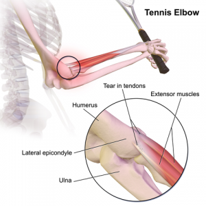 Tennis Elbow by Dr Arora and Team