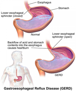 This is a article on Acid Reflux their Causes , Symptoms and Treatment by Dr Arora and Team